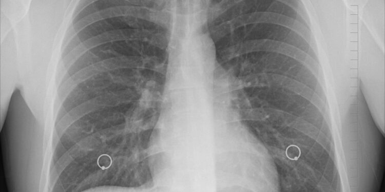 La combinación de la experiencia médica local con el uso de la IA nos da una oportunidad de vencer a la tuberculosis de una vez y para siempre. Foto: Pixabay.
